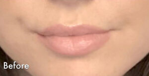 1729198019-juvederm-2b4e