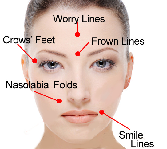 Will It Prevent Wrinkles, and Other Botox-Cosmetic Questions