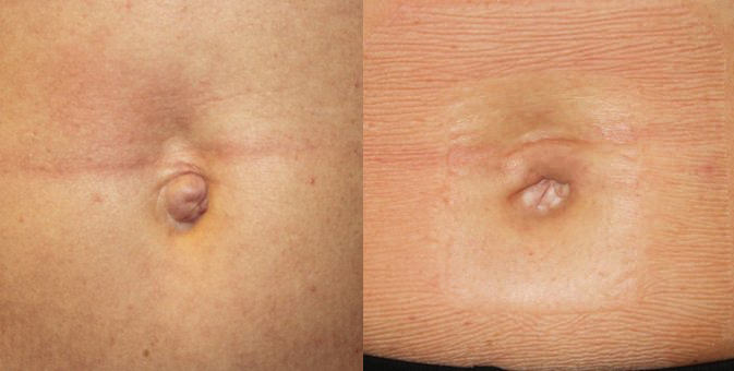 Belly Button Surgery Is a Trend and It’s On the Rise