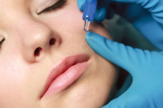 4 Real Women on Why They Got Fillers and What They Wish They Knew First