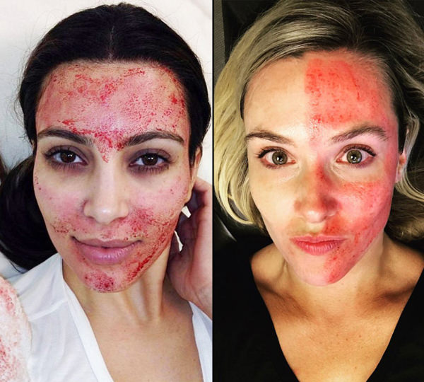 Everything You Need to Know About Getting a PRP Facelift Like Kim Kardashian