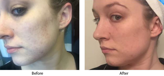 Does Microneedling Work? This Kardashian-Approved Skin Procedure Cleared My Acne Scars